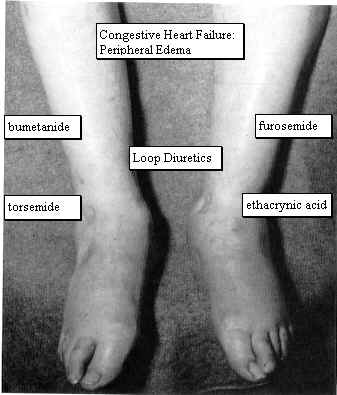 congestive heart disease